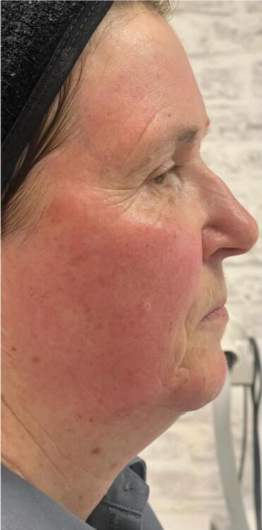 before and after collagen lift Natalie Greenhalgh at the beauty lounge