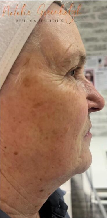 before and after collagen lift Natalie Greenhalgh at the beauty lounge