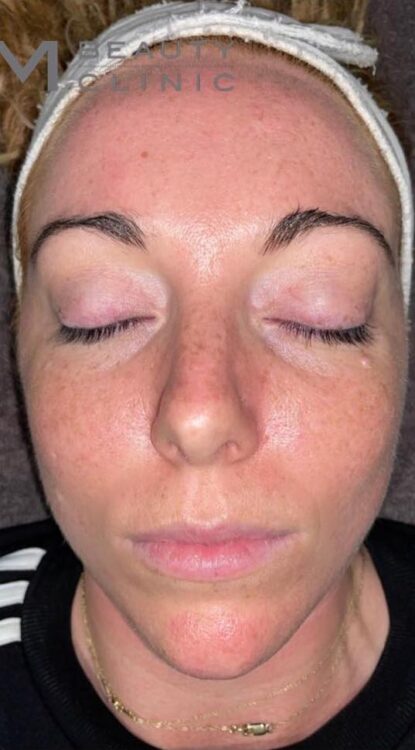 before and after microdermabrasion Natalie Marie beauty clinic