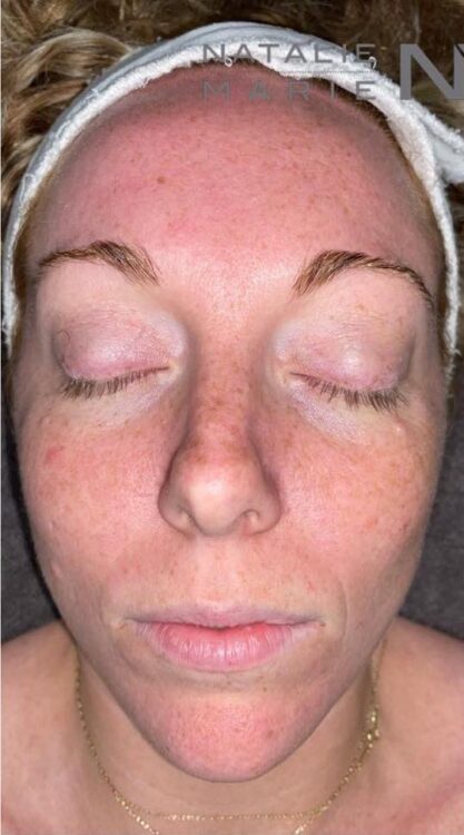 before and after microdermabrasion Natalie Marie beauty clinic