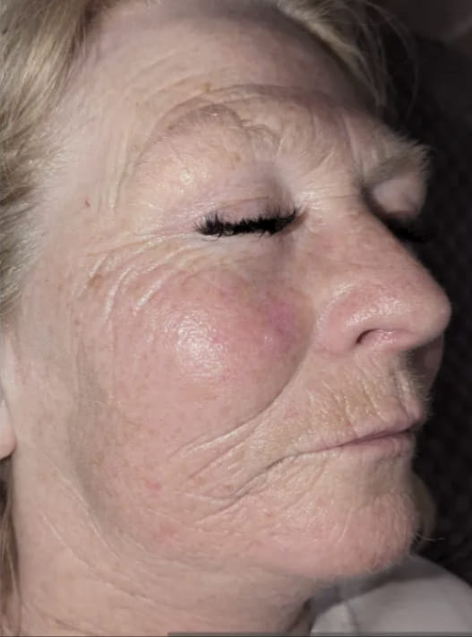 before and after collagen lift Nu You