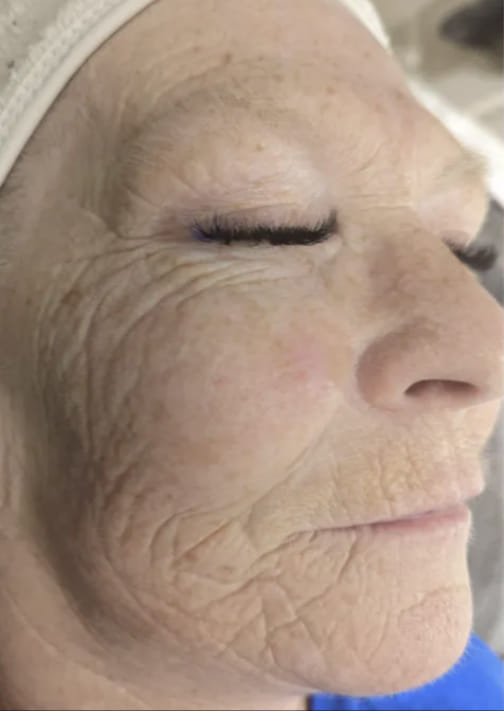 before and after collagen lift Nu You