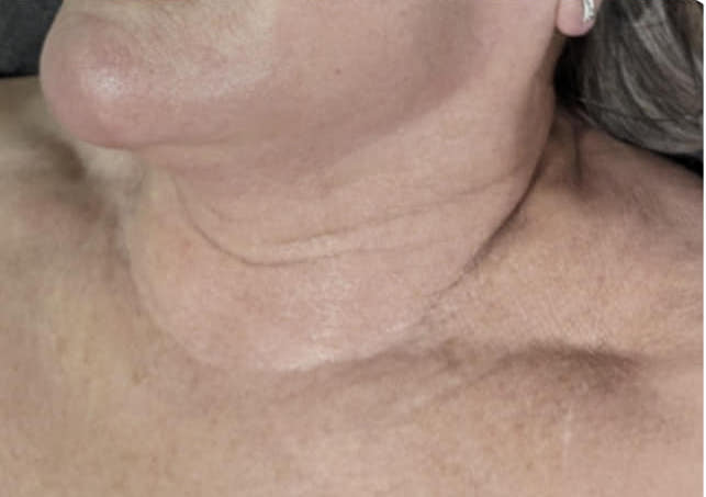before and after collagen lift nu you