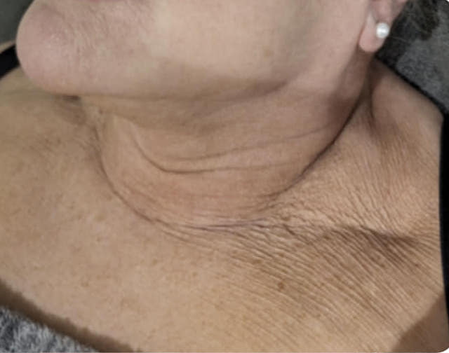before and after collagen lift nu you