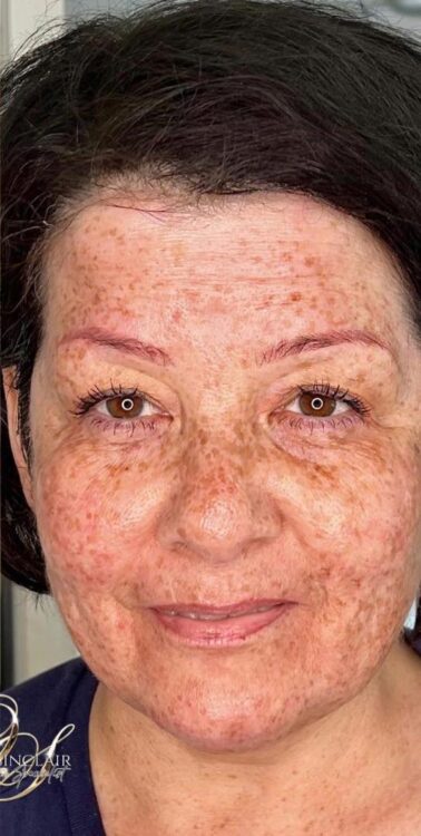 before and after collage lift Ocean Sinclair skin specialist