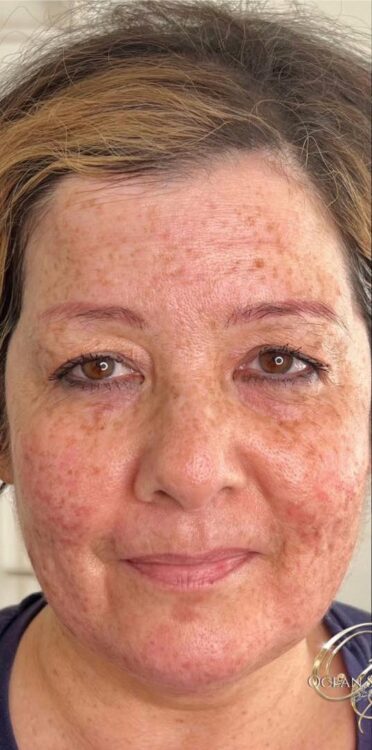 before and after collage lift Ocean Sinclair skin specialist