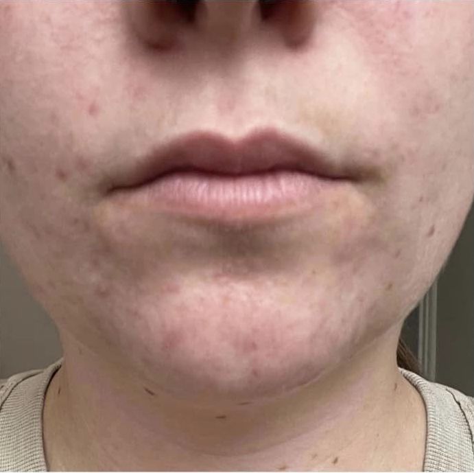 before and after microdermabrasion pamper treat repeat
