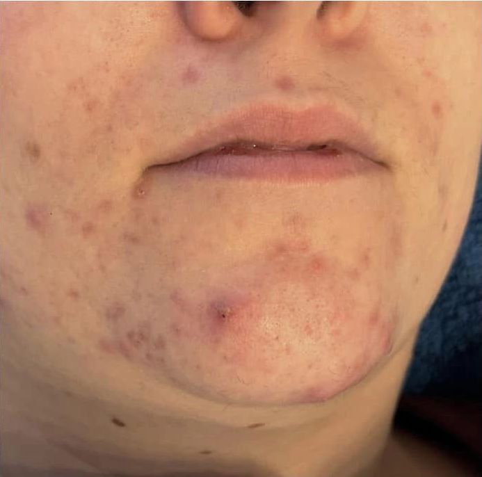 before and after microdermabrasion pamper treat repeat