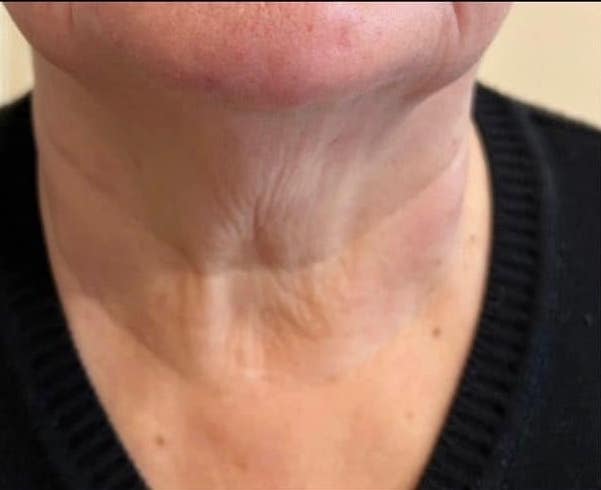 before and after collagen lift pamper treat repeat