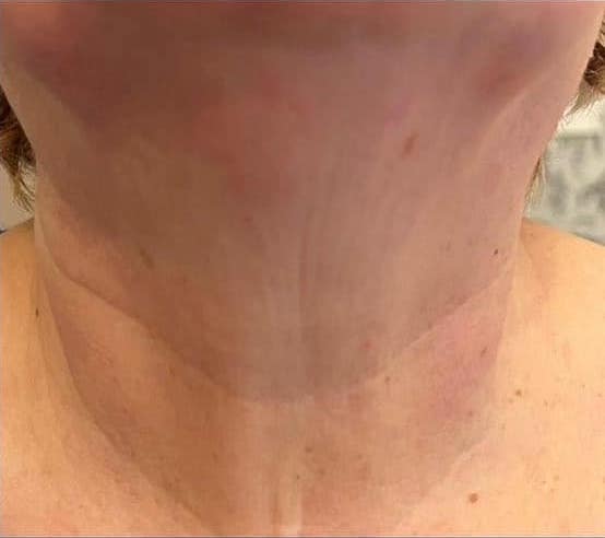 before and after collagen lift pamper treat repeat