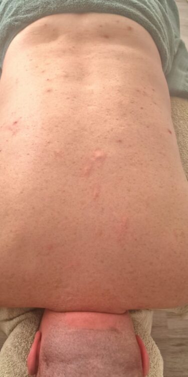before and after microdermabrasion peace lily holistics