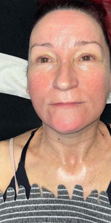 before and after collagen lift pebble health and beauty