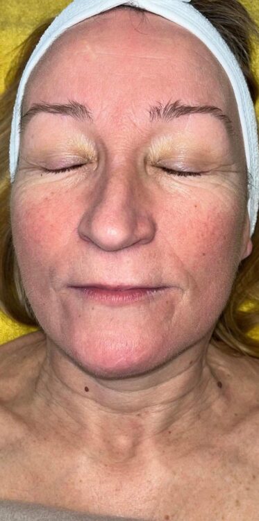 before and after collagen lift pebble health and beauty