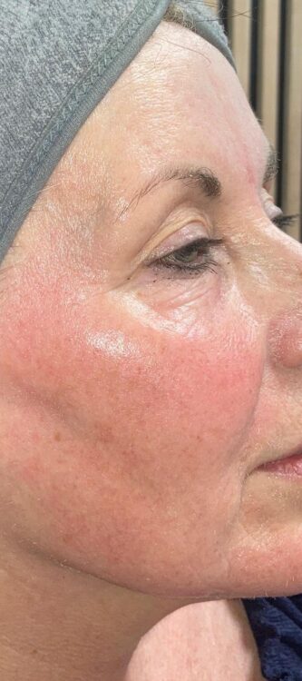 before and after collagen lift perfectly sculpted aesthetics