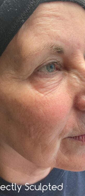 before and after collagen lift perfectly sculpted aesthetics