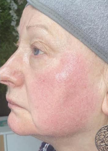 before and after collagen lift perfectly sculpted aesthetics