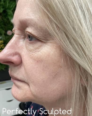 before and after collagen lift perfectly sculpted aesthetics