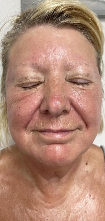before and after collagen lift pure beauty by Steph