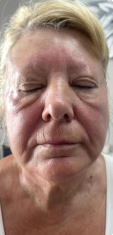 before and after collagen lift pure beauty by Steph