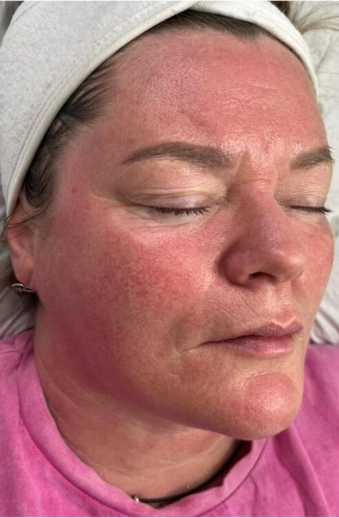 before and after collagen lift Rebecca Charles laser and skin clinic
