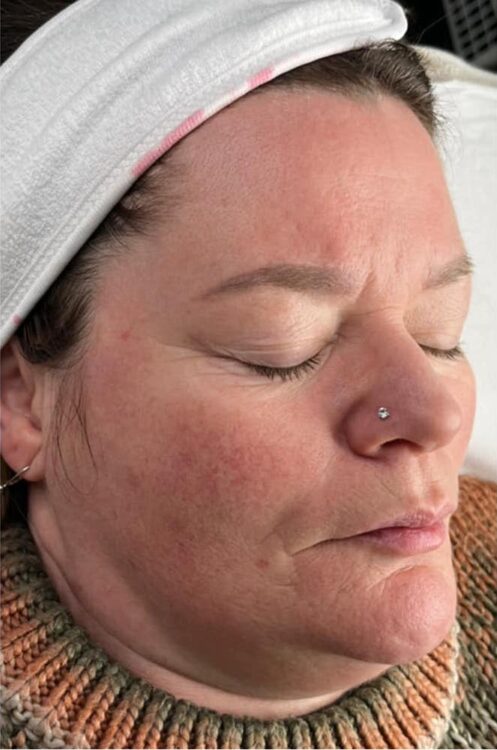before and after collagen lift Rebecca Charles laser and skin clinic