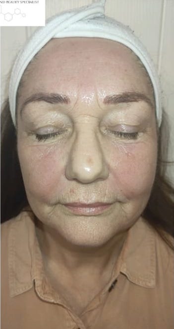 before and after collagen lift Rebecca Willshee nail and beauty specialist