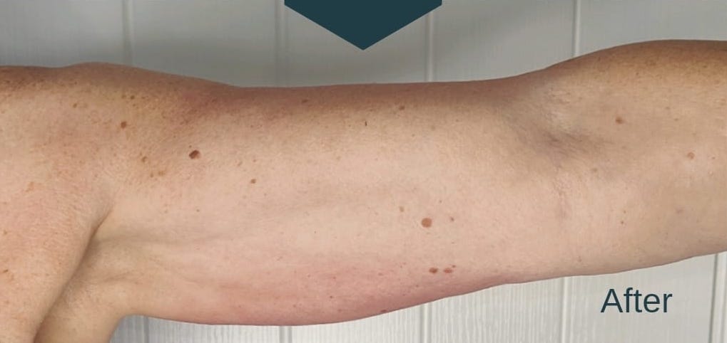 before and after collagen lift Rebecca Willshee nail and beauty specialist