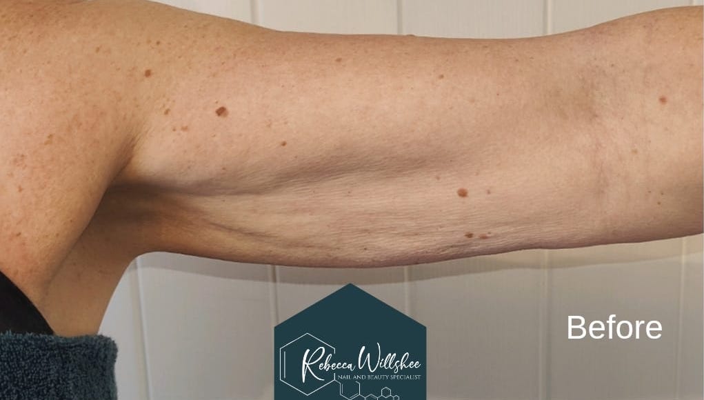 before and after collagen lift Rebecca Willshee nail and beauty specialist