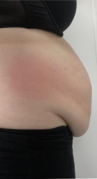 before and after collagen lift revive health and beauty