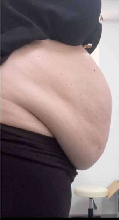 before and after collagen lift revive health and beauty
