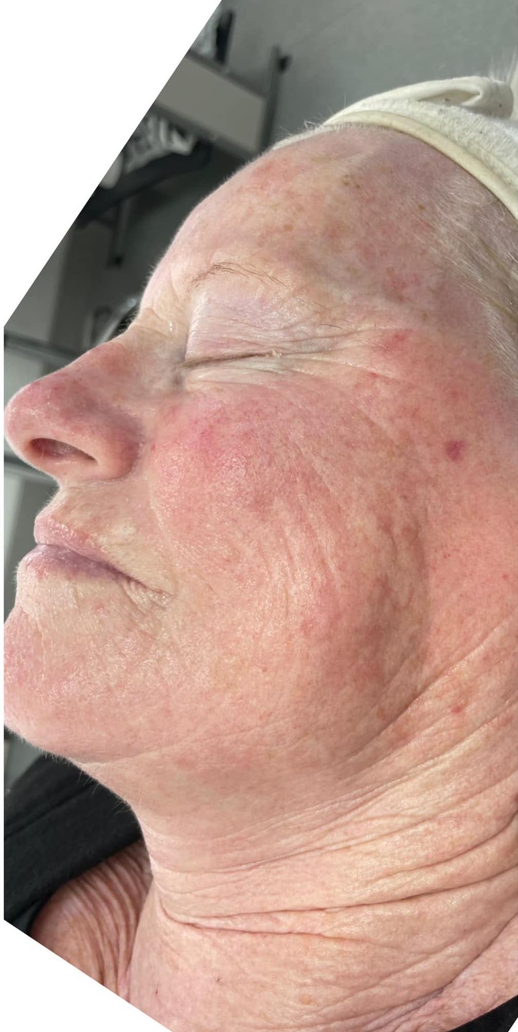 before and after collagen lift ultimate revive health and beauty