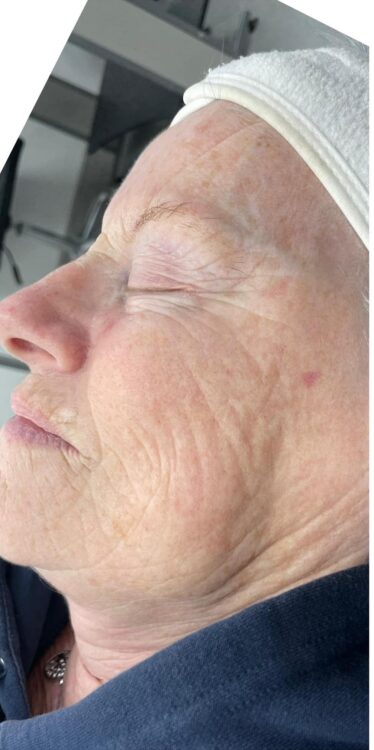 before and after collagen lift ultimate revive health and beauty