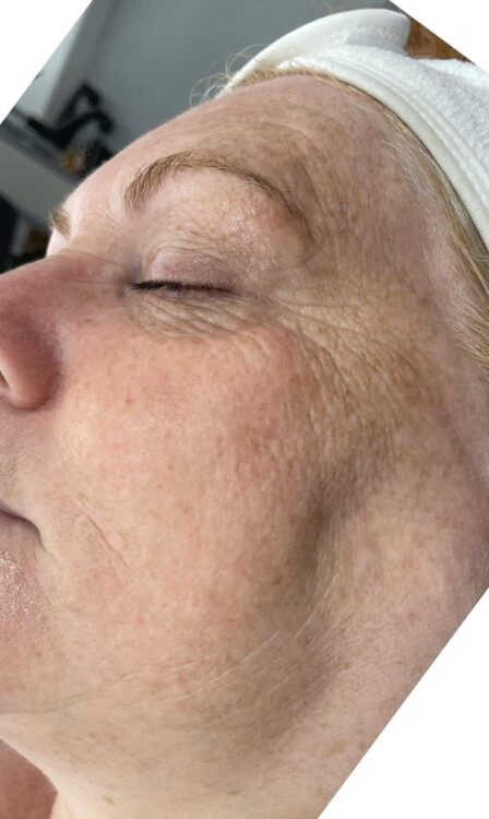 before and after collagen lift ultimate revive health and beauty
