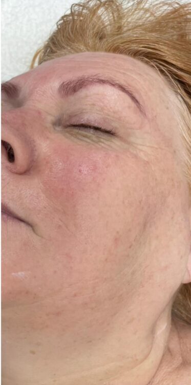 before and after collagen lift ultimate revive health and beauty