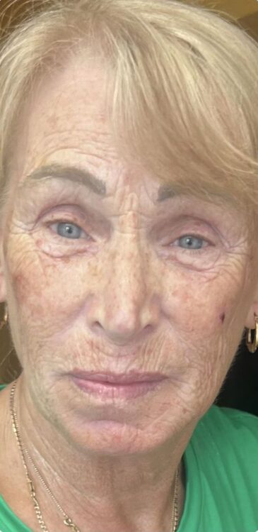 before and after collagen lift rising dawn aesthetics