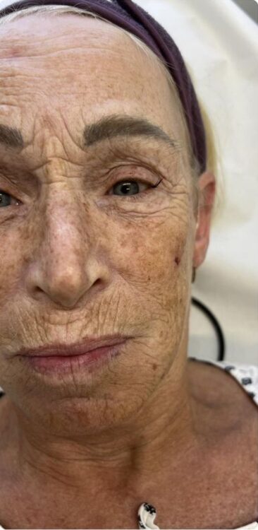 before and after collagen lift rising dawn aesthetics