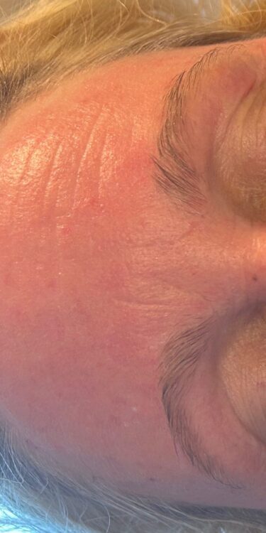 before and after microdermabrasion ayano spa