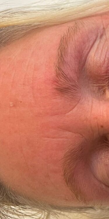 before and after microdermabrasion ayano spa