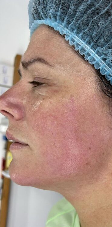 before and after collagen lift simply youthful aesthetics