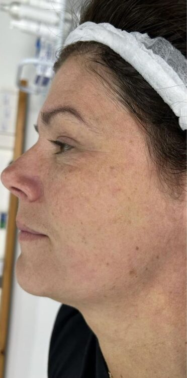 before and after collagen lift simply youthful aesthetics