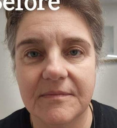 before and after collagen lift skinplicity