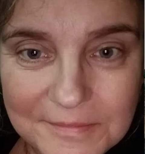 before and after collagen lift skinplicity