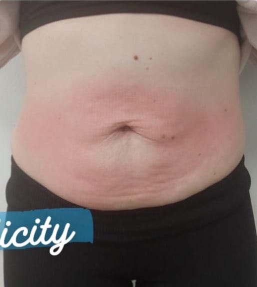 before and after collagen lift skinplicity