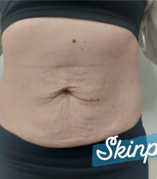 before and after collagen lift skinplicity