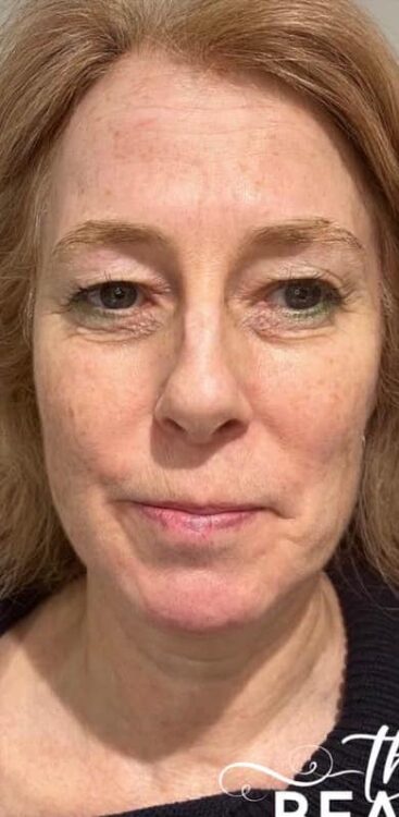 before and after collagen lift the beauty room