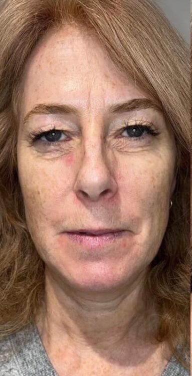 before and after collagen lift the beauty room
