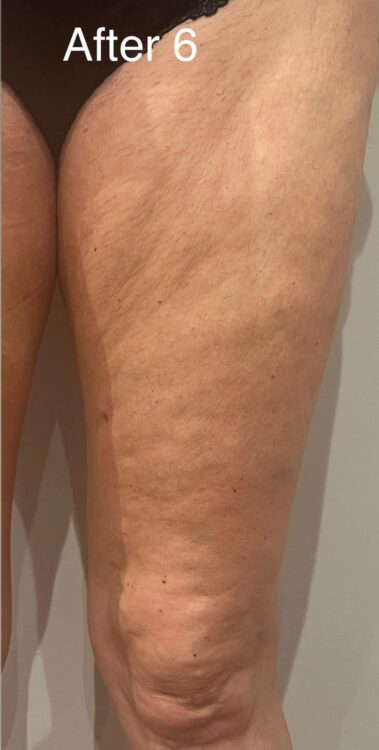 before and after collagen lift the beauty room wrington