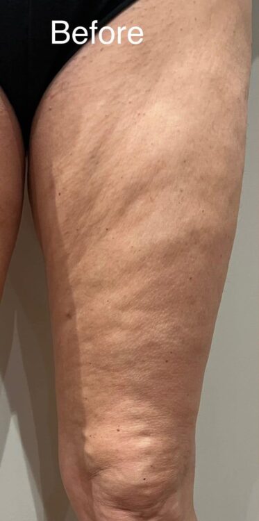 before and after collagen lift the beauty room wrington