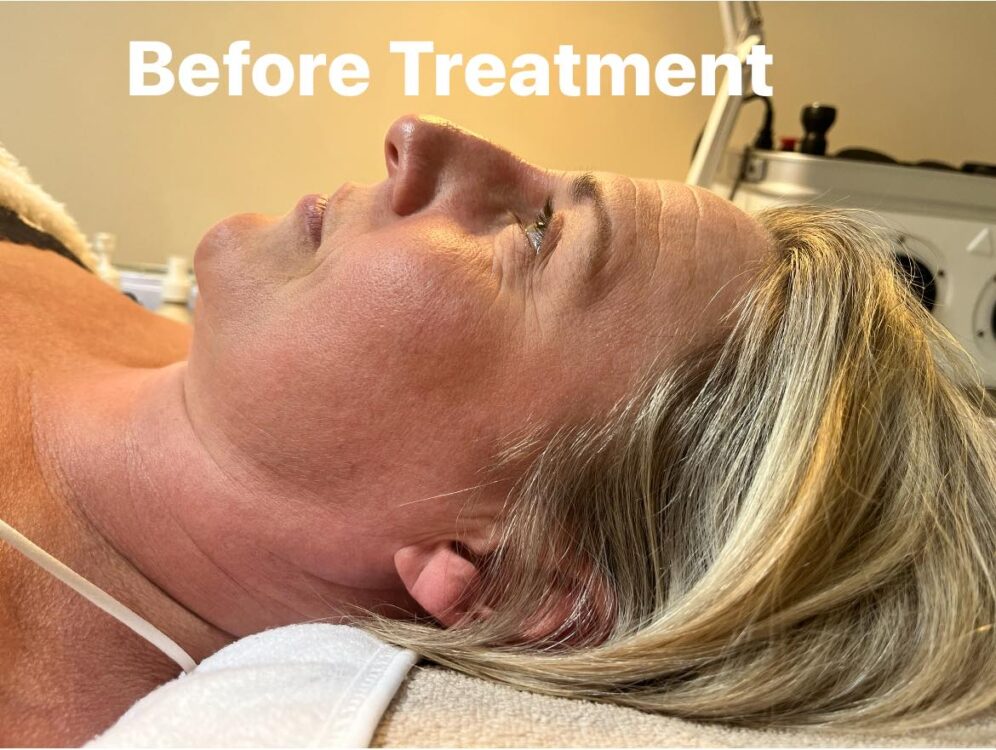 before and after collagen lift the beauty shed by carley