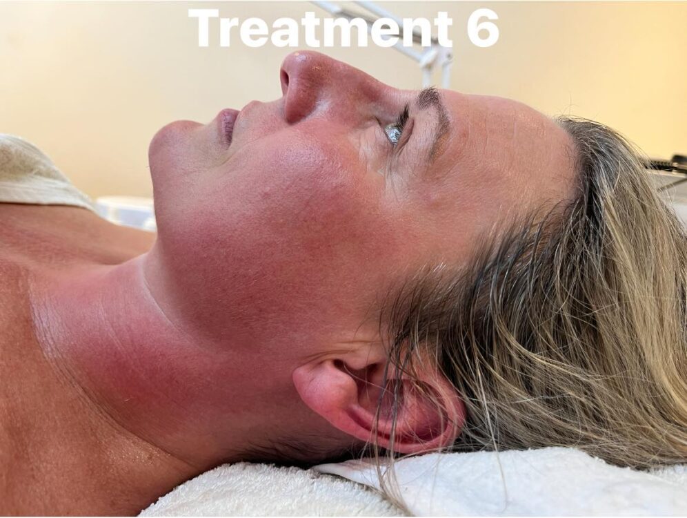 before and after collagen lift the beauty shed by carley